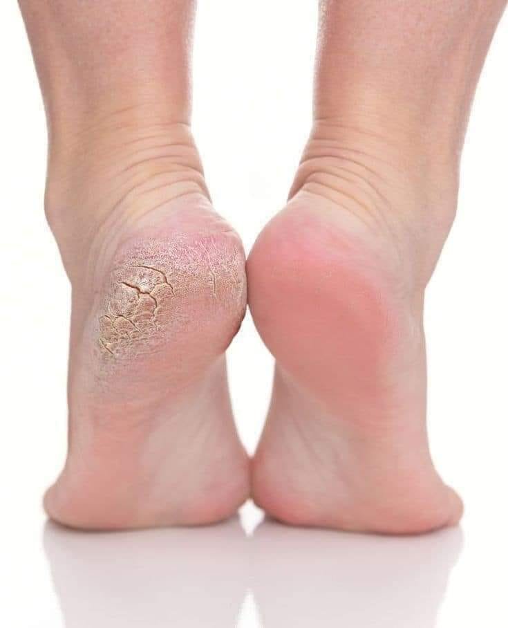 Foot peeling
مقشر القدم الفوري - الصورة 3