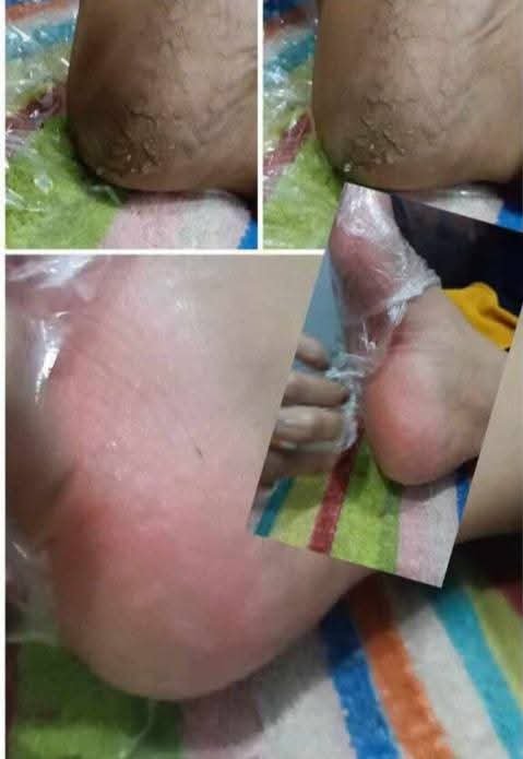 Foot peeling
مقشر القدم الفوري - الصورة 4